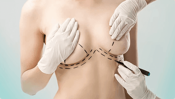 Breast reconstruction cover